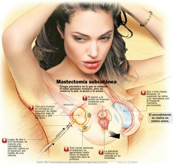 mastectomia profilactica
