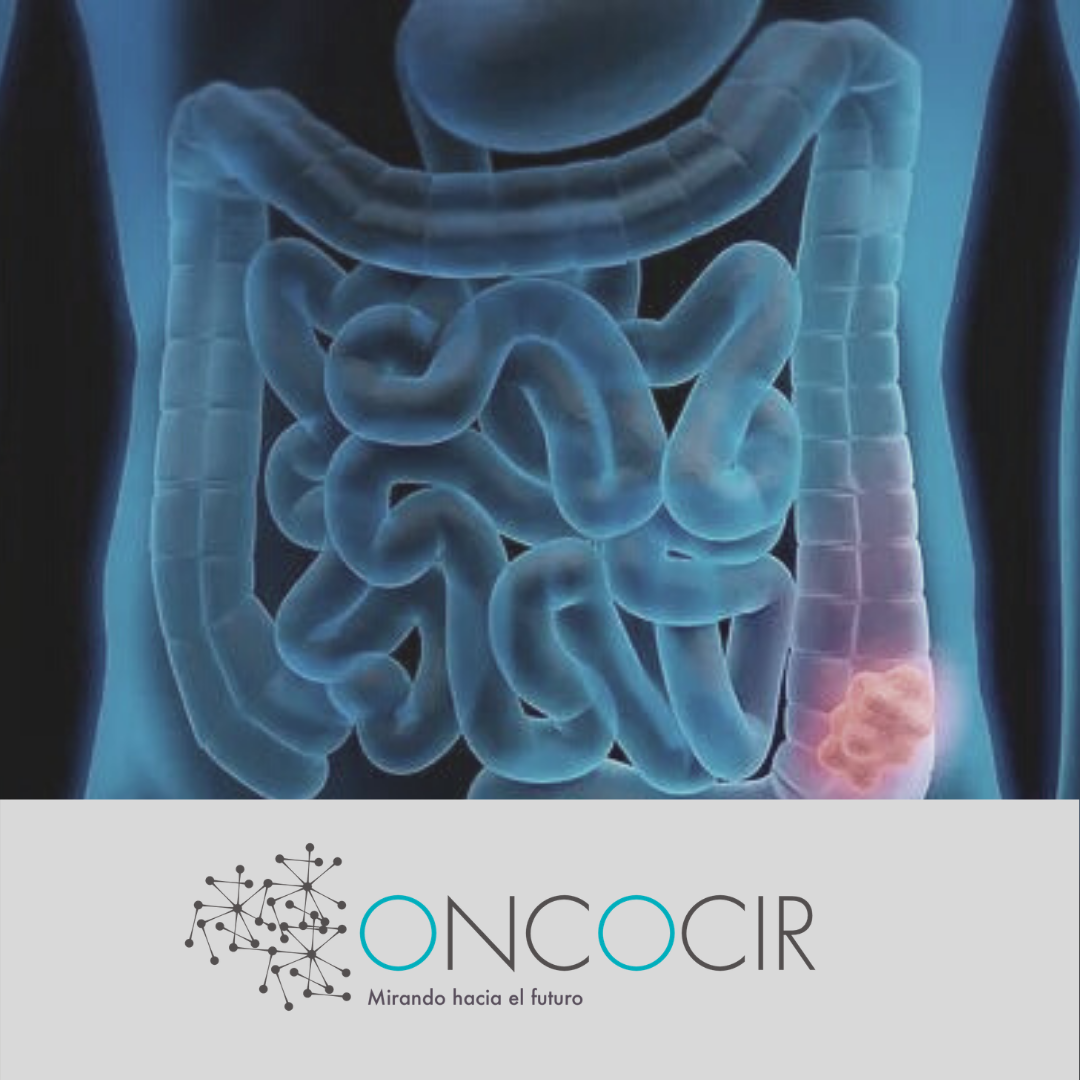 cancer colorrectal