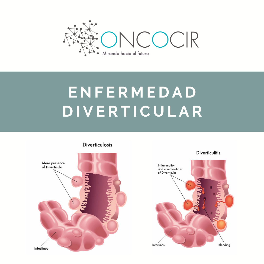 diverticulos