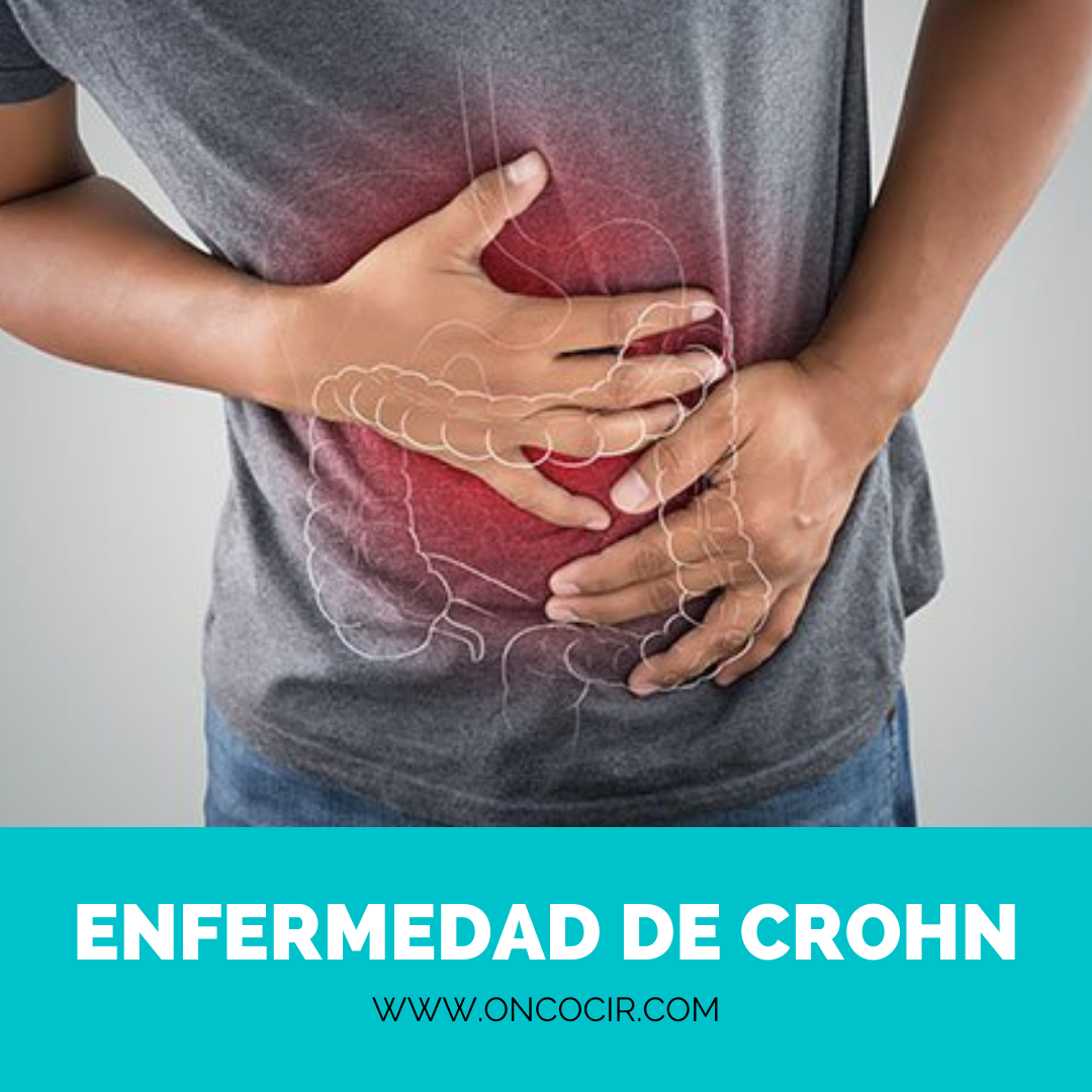enfermedad de crohn