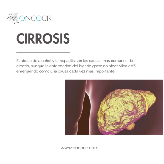 cirrosis